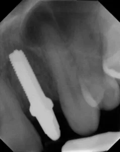 The Difference Between Metal-Free Dental Implants And Bridges Silver Spring, MD | Sammy Noumbissi DDS