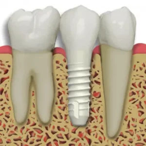Metal-Free Implant Dentistry Summit Dec 7 and 8 2012 Miami FL USA | Miles Of Smiles Implant Dentistry