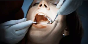 Dental Fillings Silver Spring & Baltimore Maryland | Dr. Sammy Noumbissi