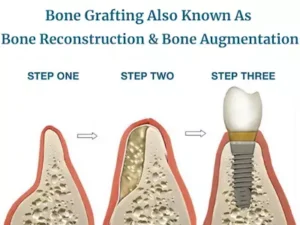 Types of Bone Grafts Silver Spring, Columbia, & Baltimore, MD | Sammy Noumbissi DDS