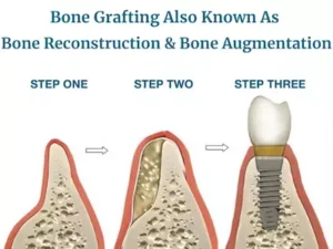 Bone Grafting Silver Spring, Columbia, & Baltimore, MD | Sammy Noumbissi DDS